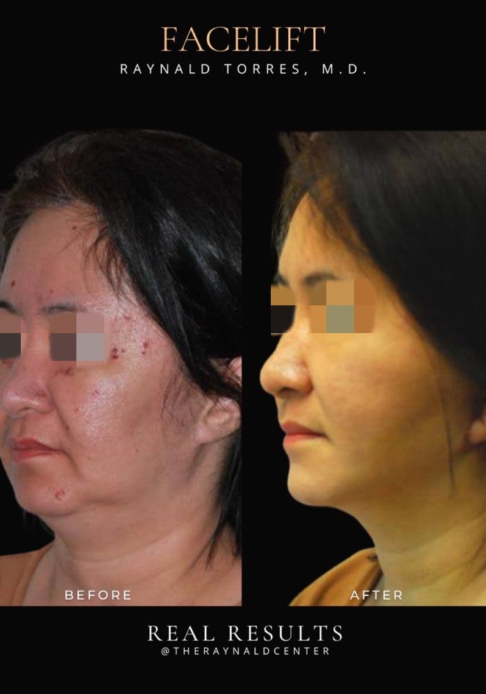 Portait_FACELIFT_Before and After Template 2025 - 23