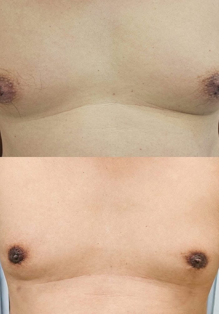 Gynecomastia