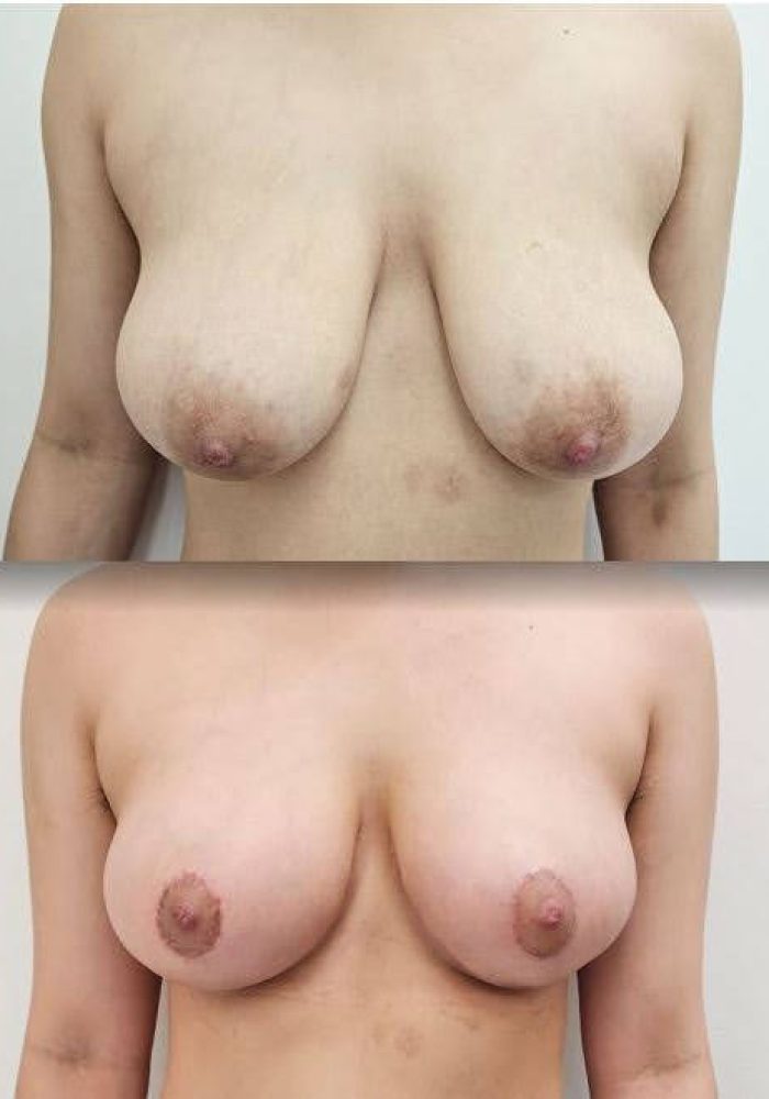 Horizontal Breast 5