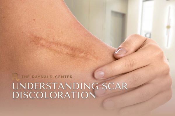Understanding Scar Discoloration After Plastic Surgery