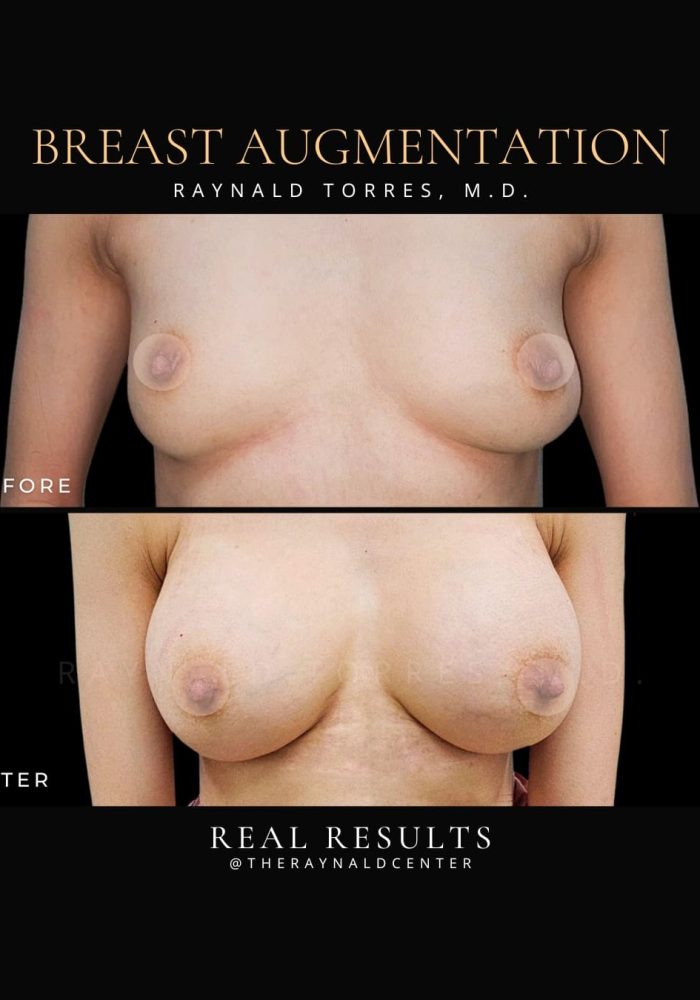breast-augmentation10