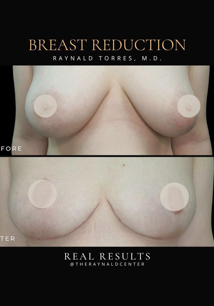 breast-reduction4
