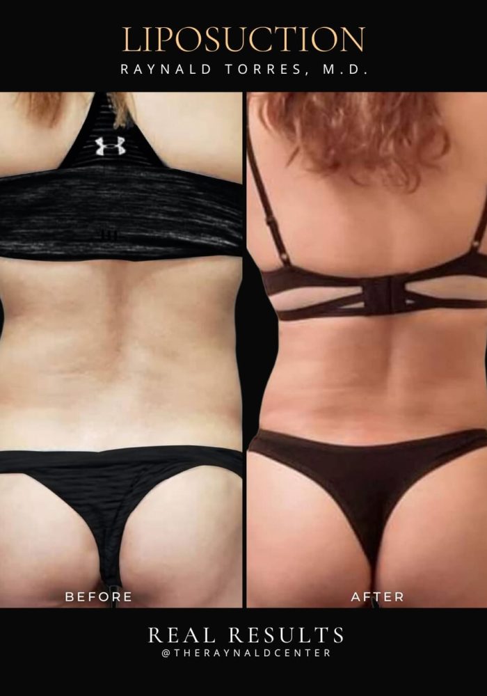 liposuction10