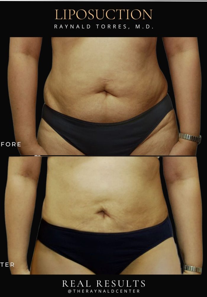 liposuction5