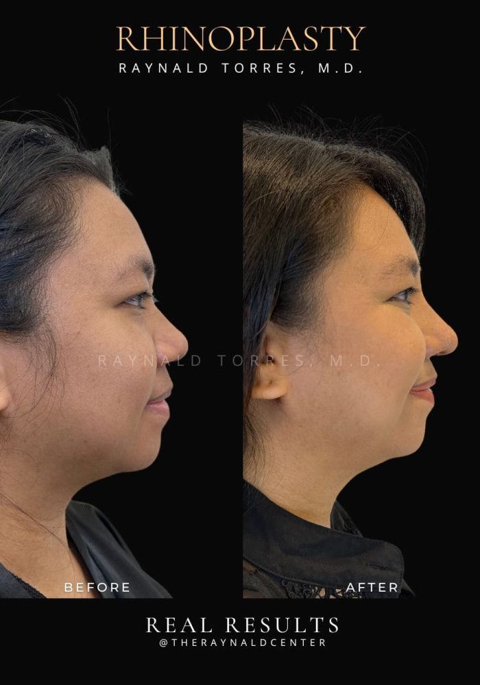 rhinoplasty-2