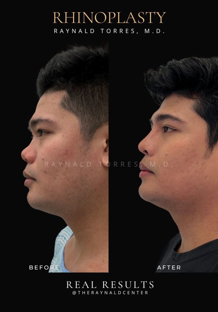 rhinoplasty14