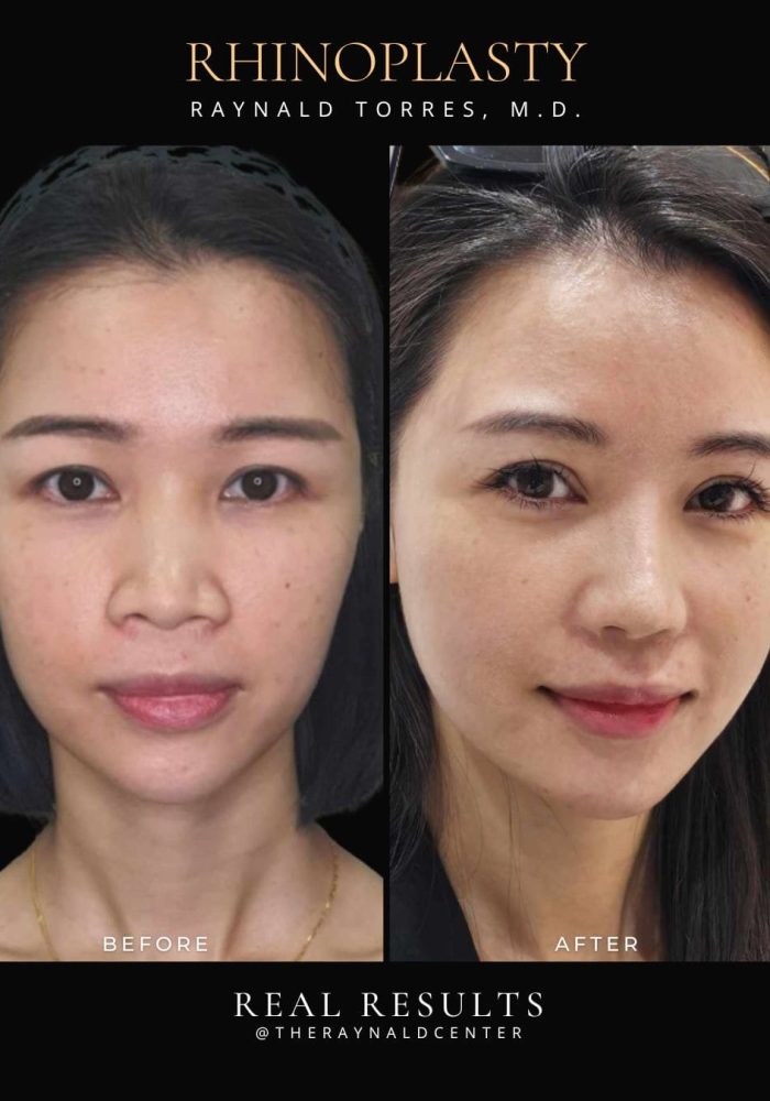 rhinoplasty40