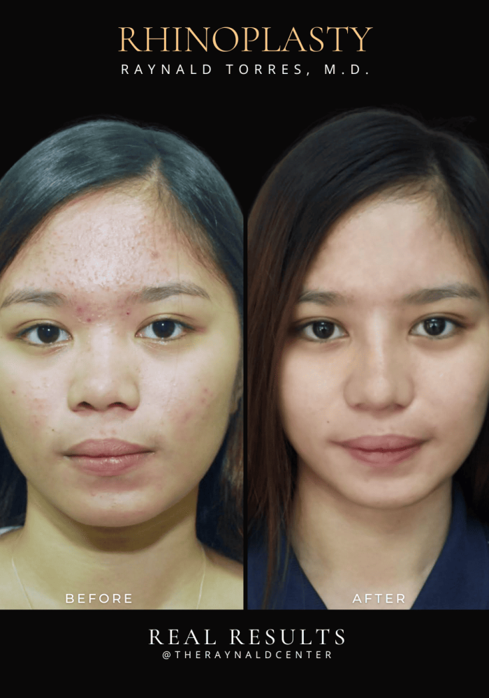 rhinoplasty52