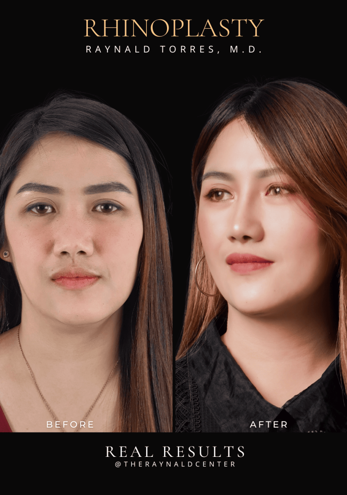 rhinoplasty6