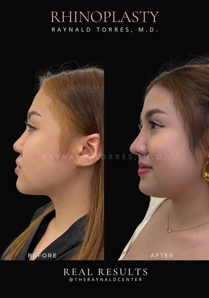 rhinoplasty9